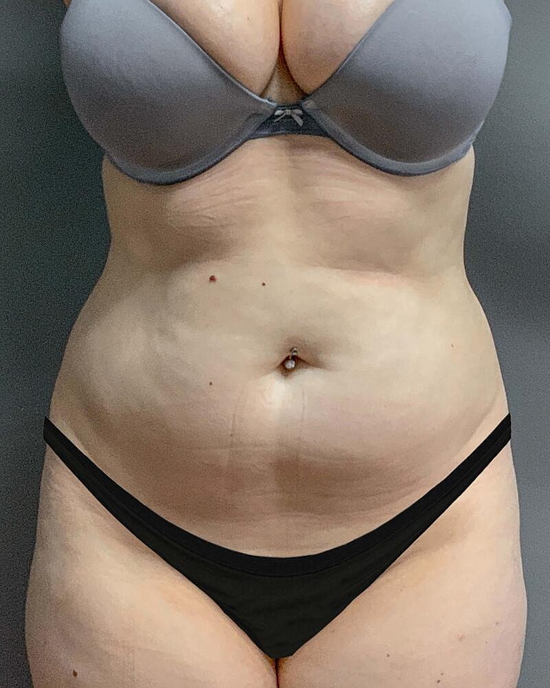 Liposuction Before & After