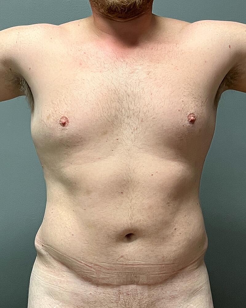 Liposuction Before & After