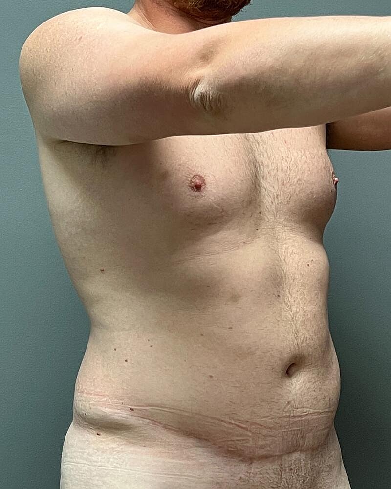 Liposuction Before & After