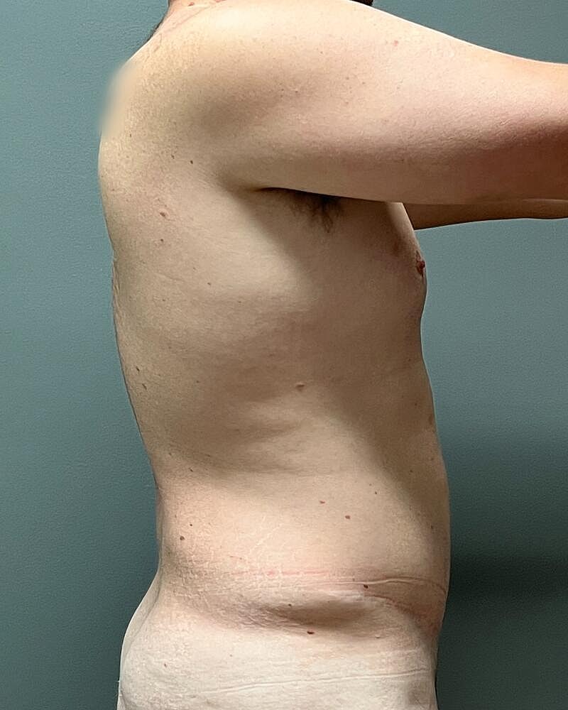 Liposuction Before & After