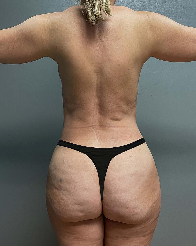 Liposuction Before & After