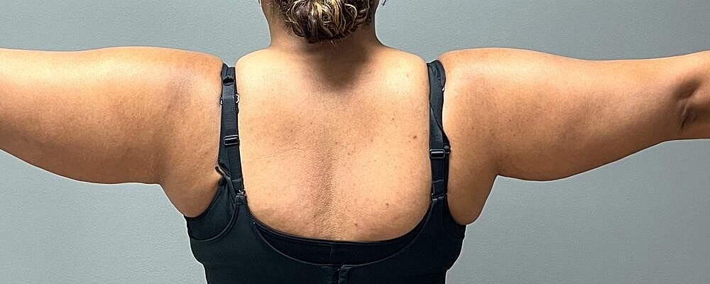 Liposuction Before & After