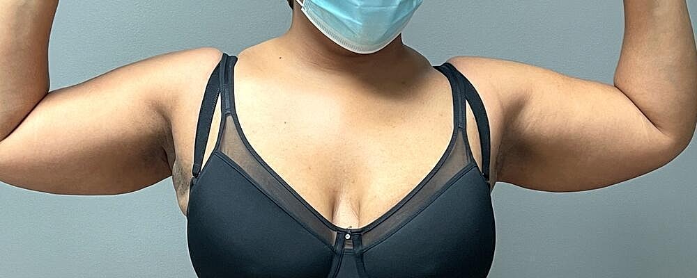 Liposuction Before & After