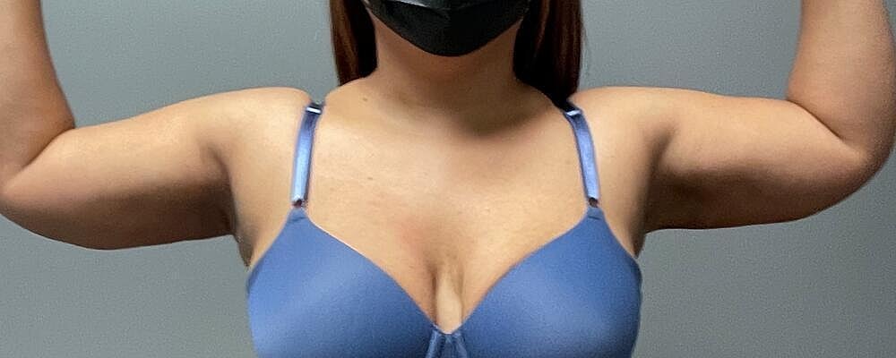 Liposuction Before & After