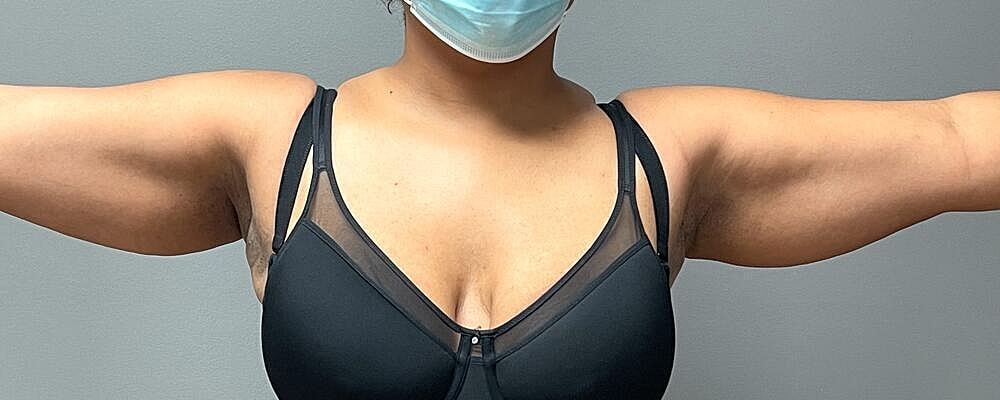 Liposuction Before & After