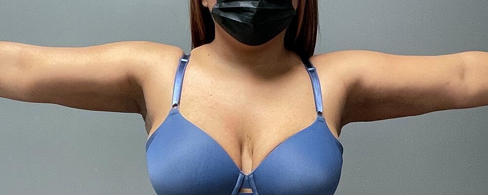Liposuction Before & After
