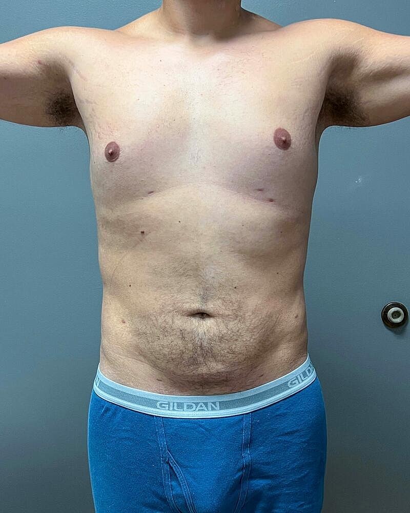 Liposuction Before & After