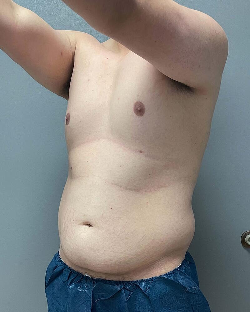 Liposuction Before & After