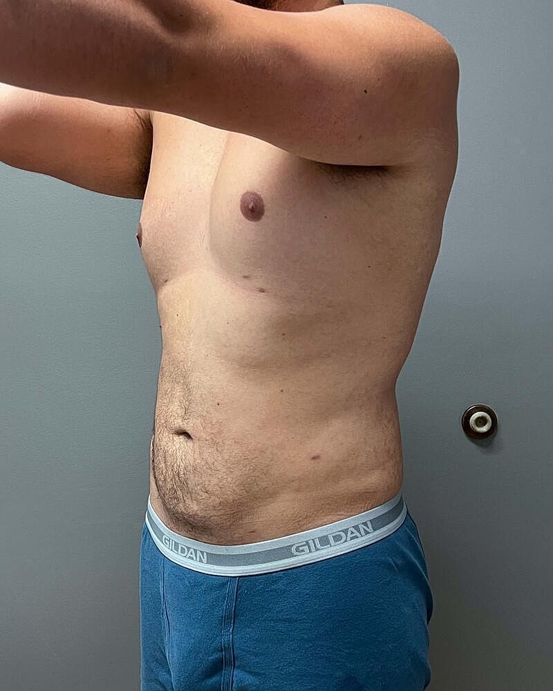 Liposuction Before & After