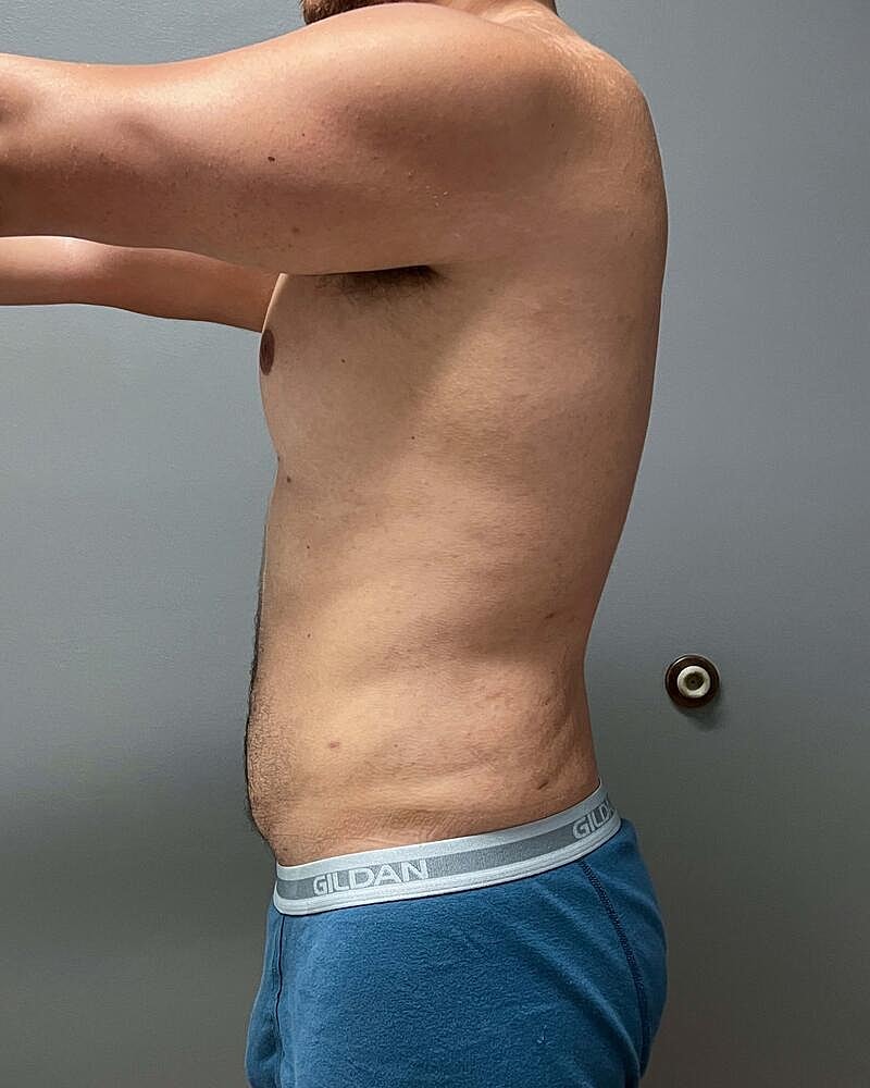 Liposuction Before & After