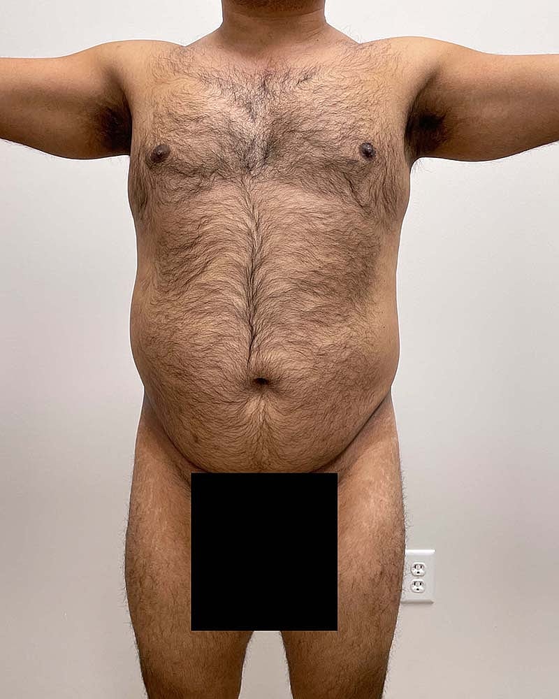 Liposuction Before & After