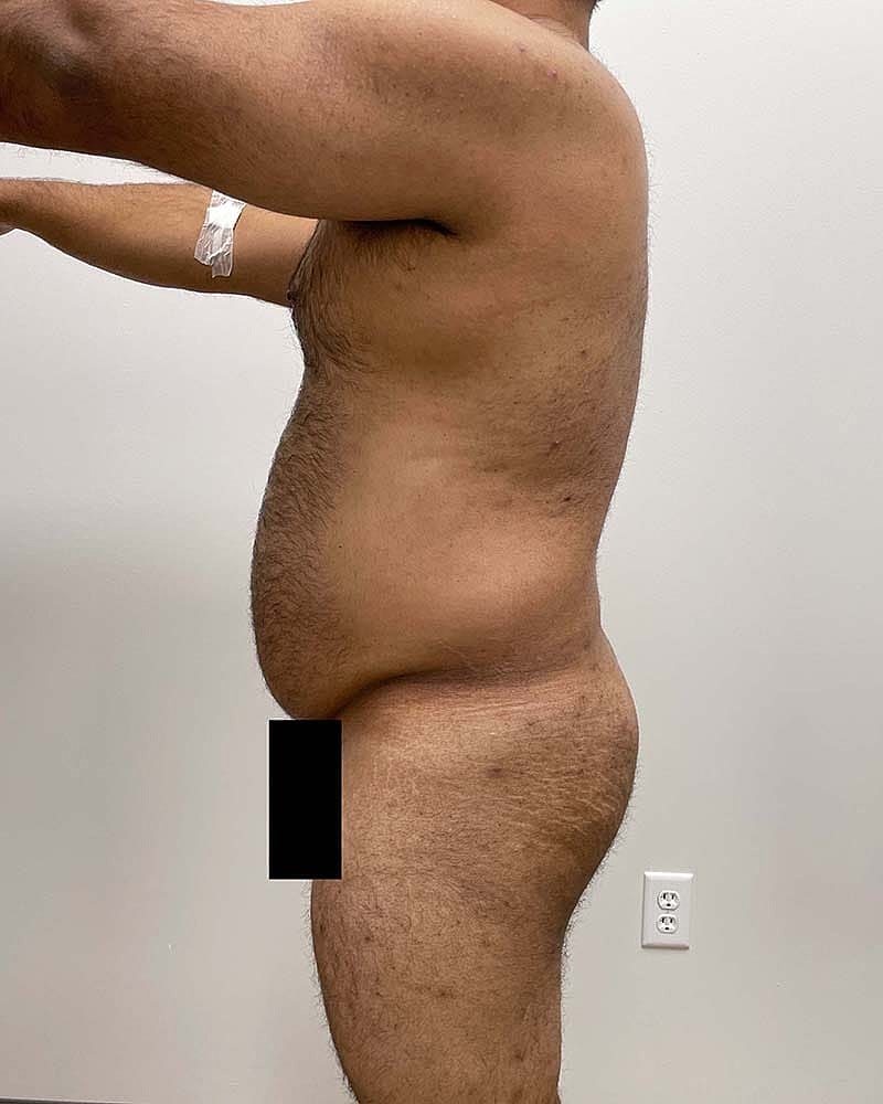 Liposuction Before & After