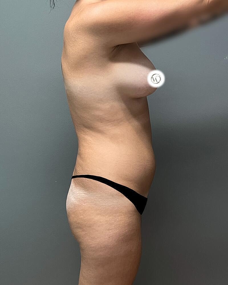 Liposuction Before & After