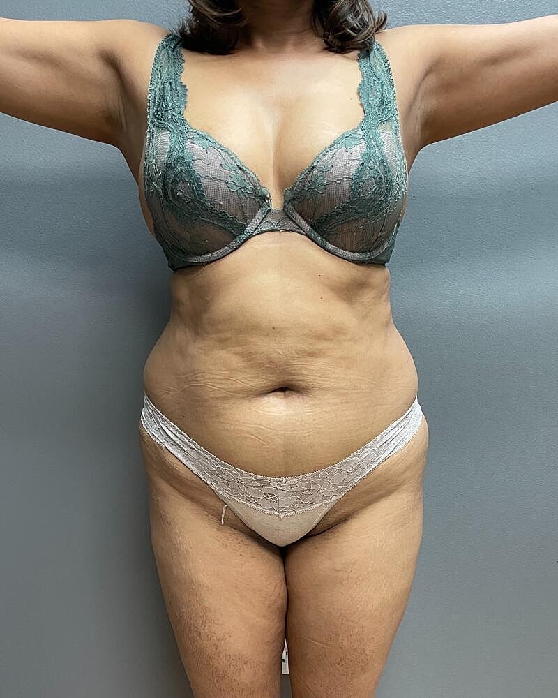 Liposuction Before & After
