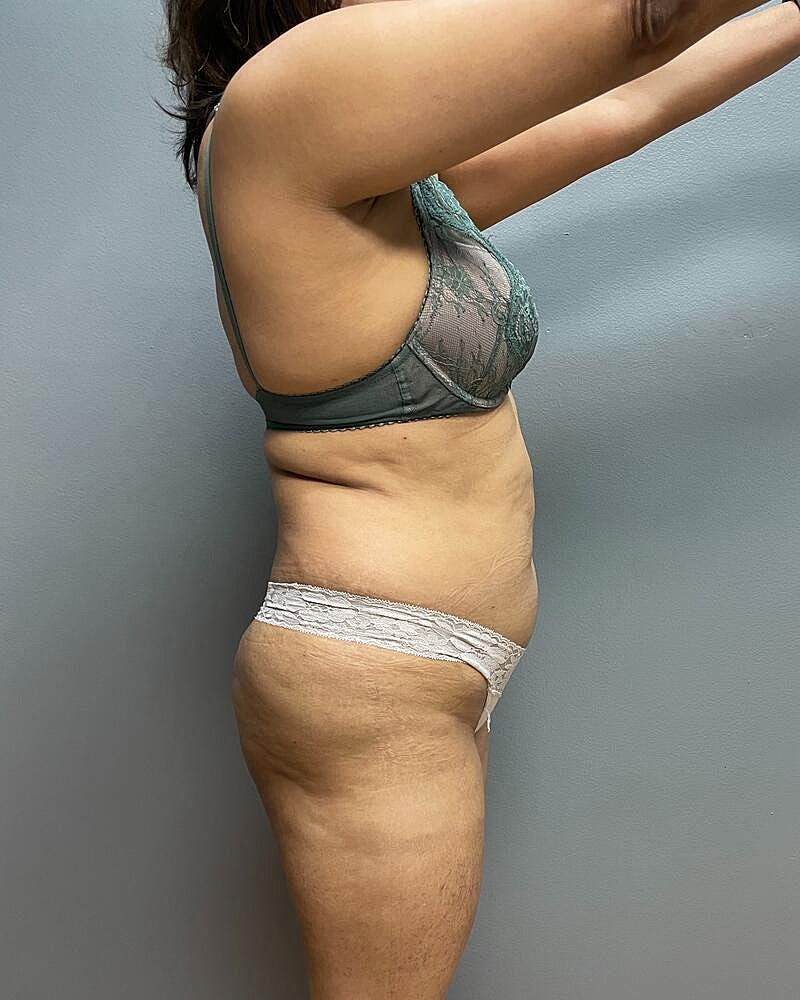 Liposuction Before & After