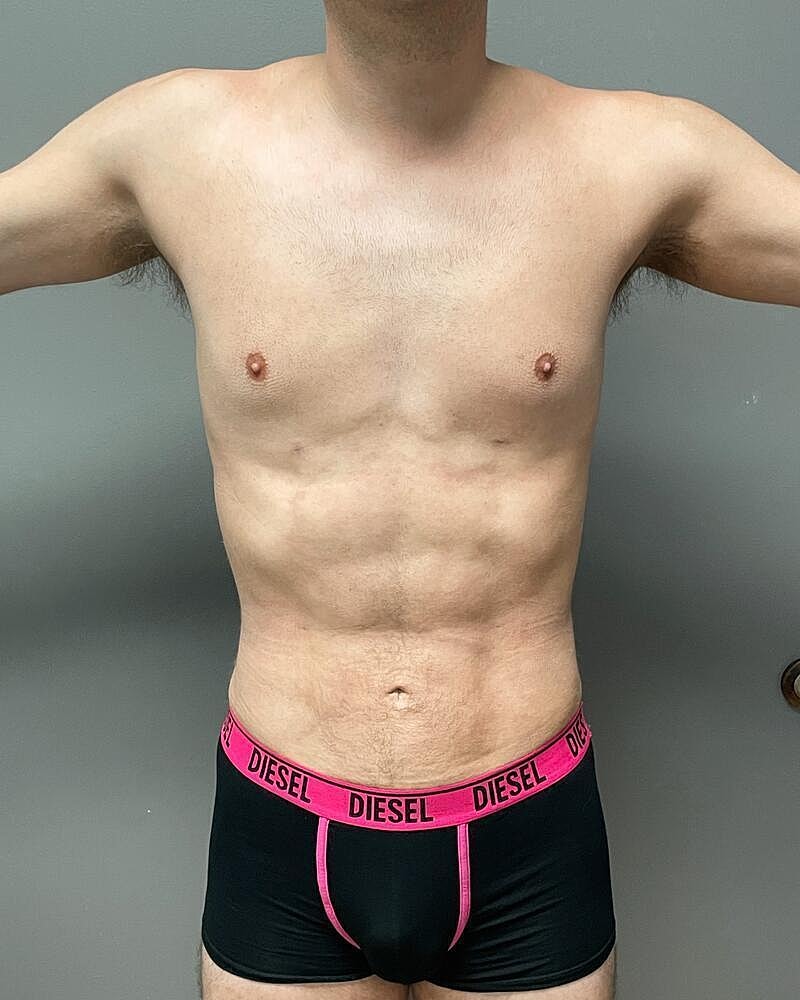 Liposuction Before & After
