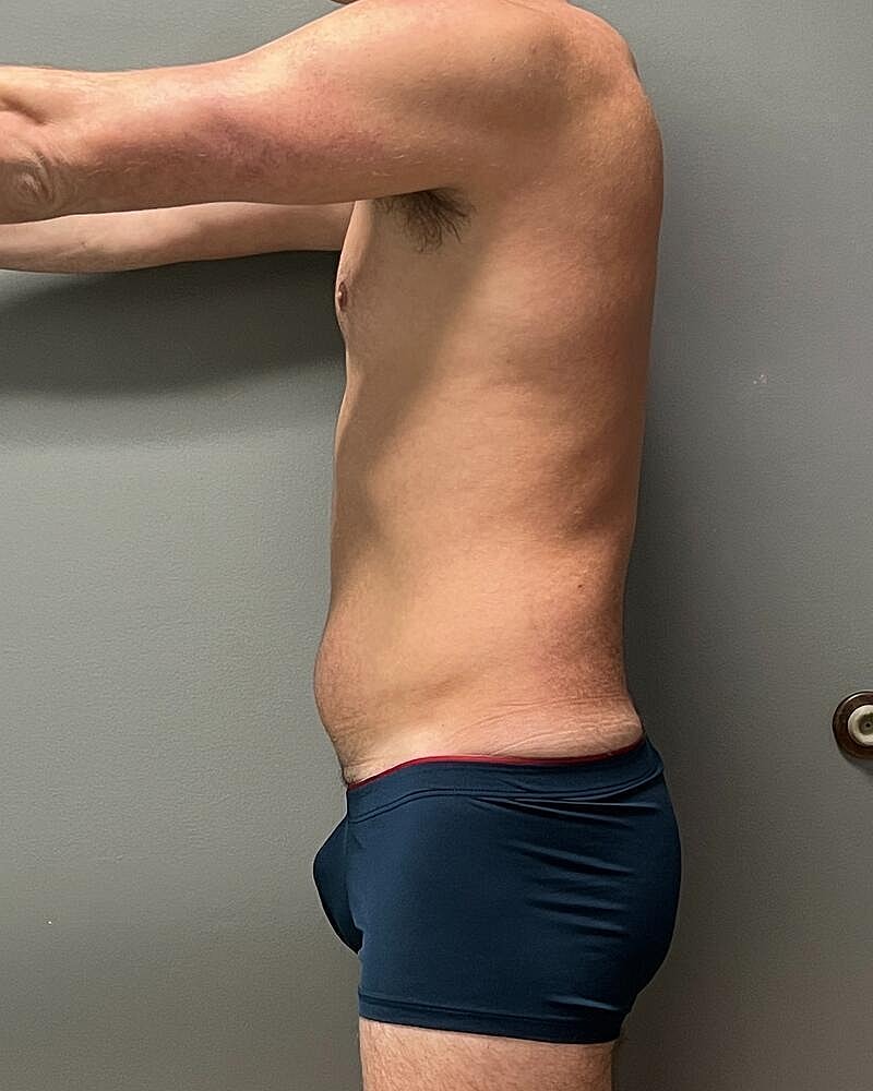 Liposuction Before & After