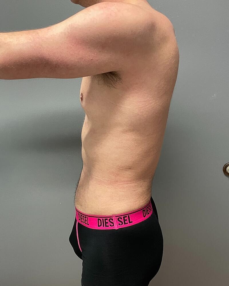 Liposuction Before & After