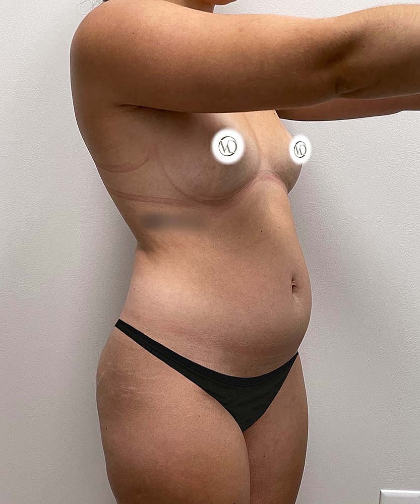 Liposuction Before & After
