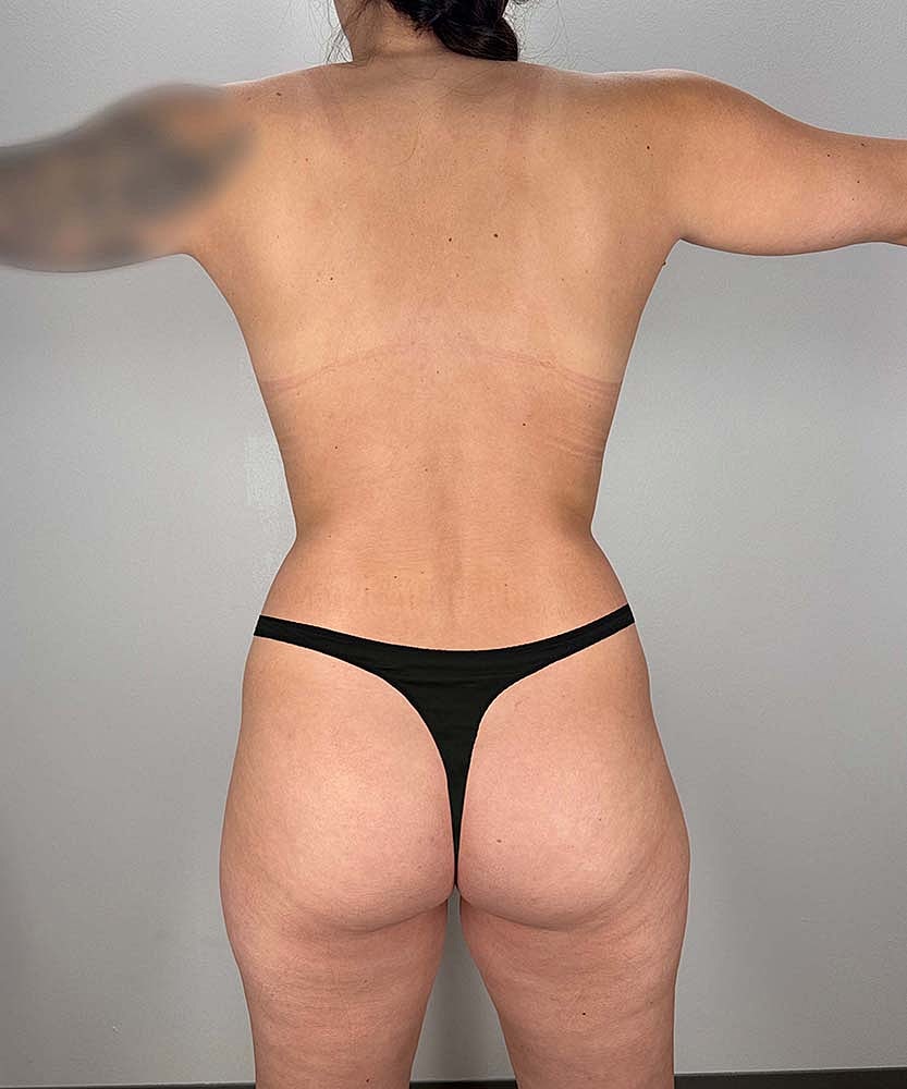 Liposuction Before & After