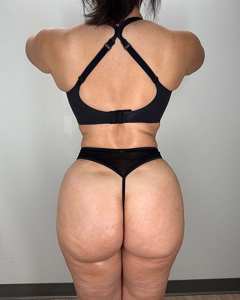Liposuction Before & After