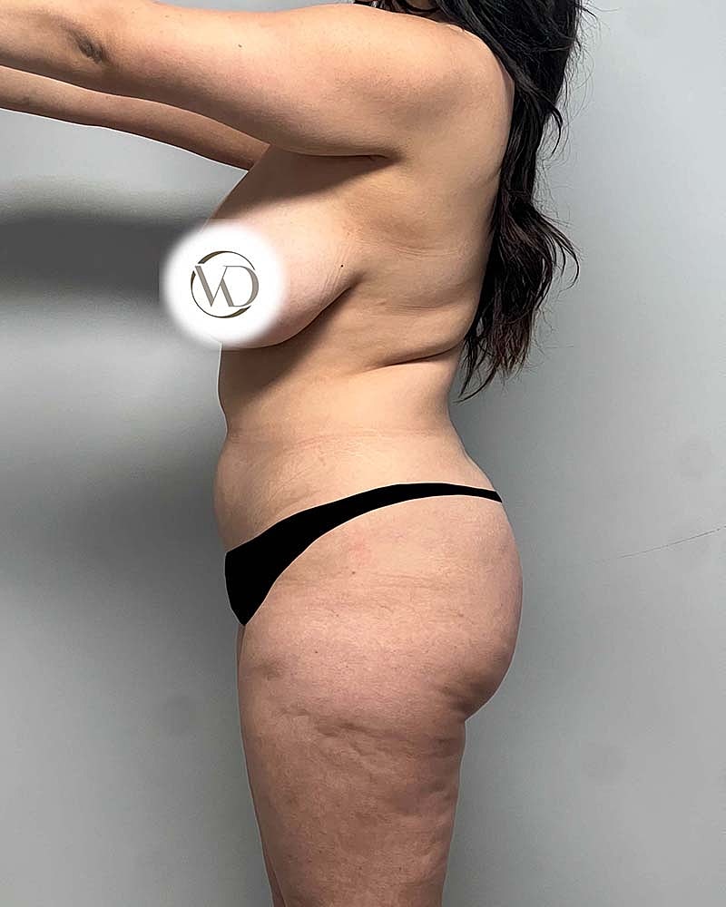 Liposuction Before & After