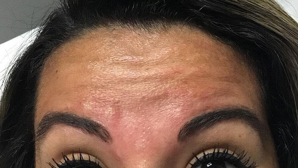 Botox Before & After