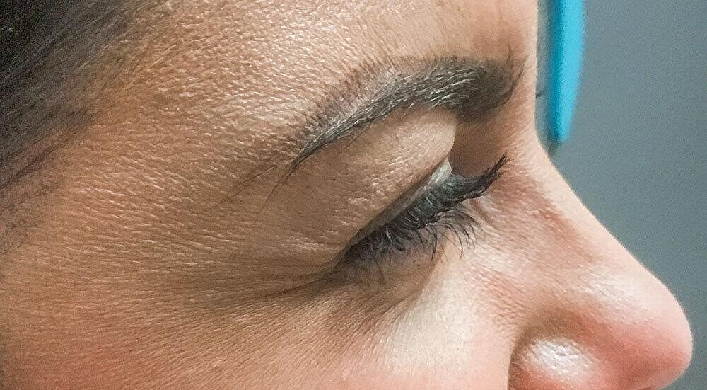 Botox Before & After