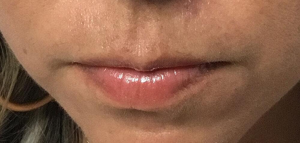 Botox Before & After