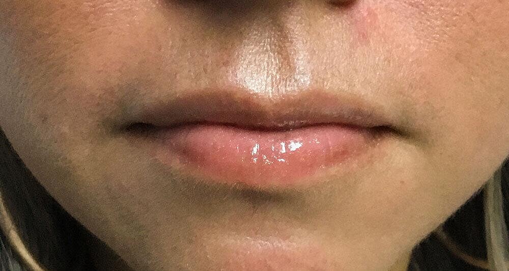 Botox Before & After
