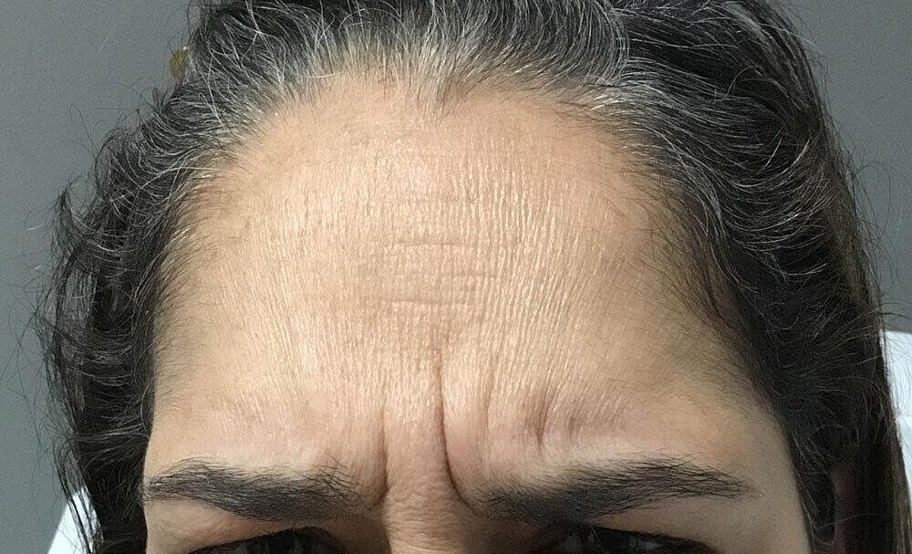 Botox Before & After