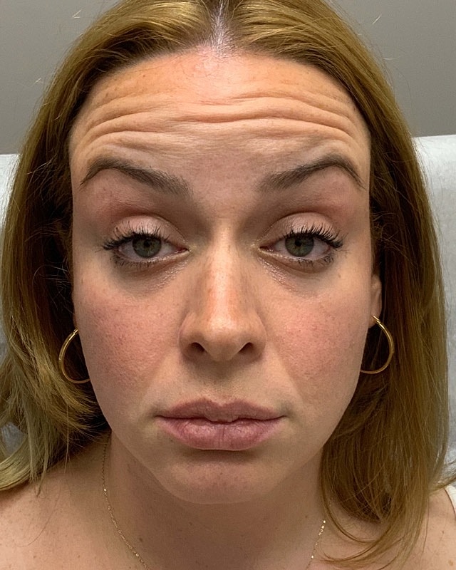 Botox Before & After