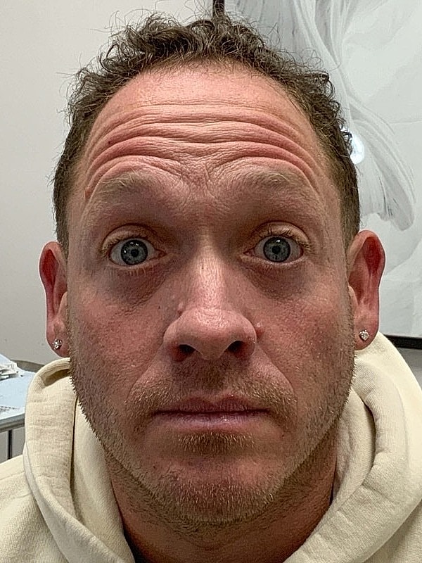 Botox Before & After