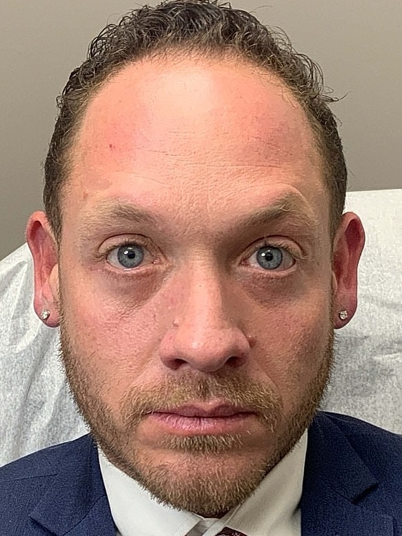 Botox Before & After