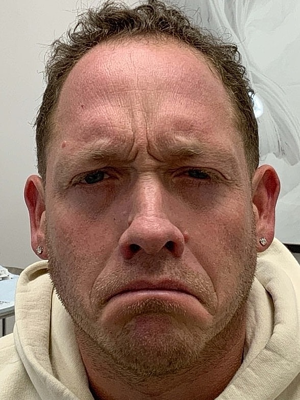 Botox Before & After