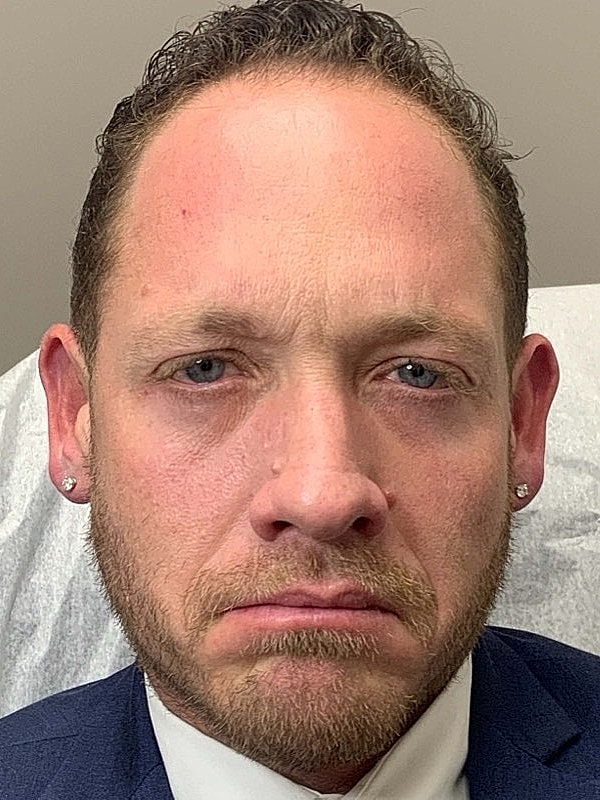 Botox Before & After