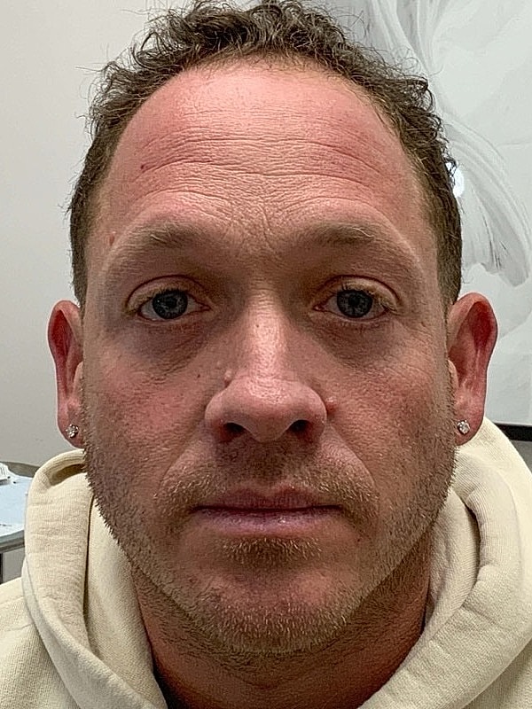 Botox Before & After