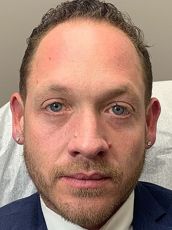 Botox Before & After