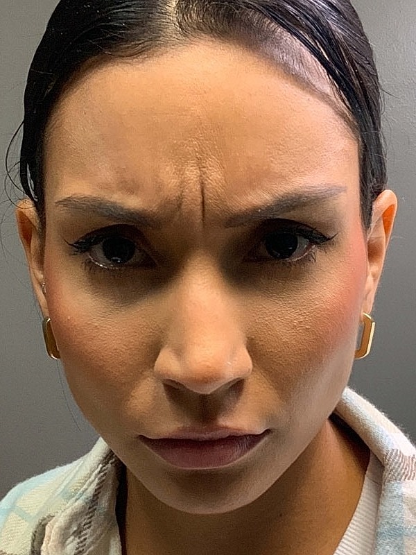 Botox Before & After