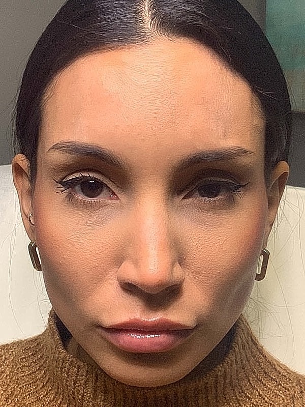 Botox Before & After