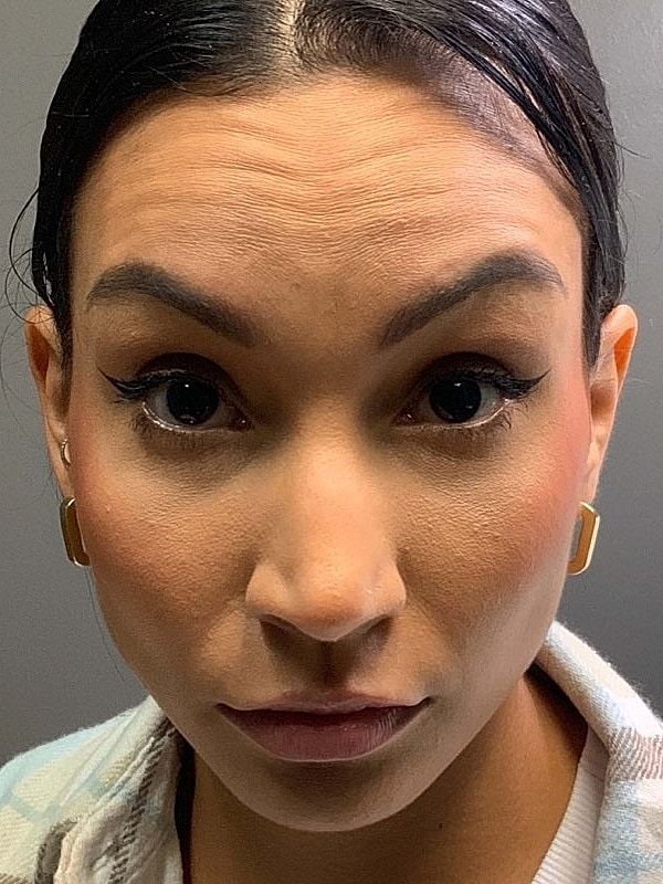 Botox Before & After