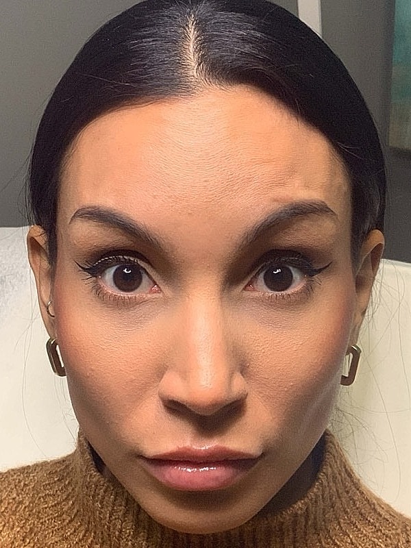 Botox Before & After