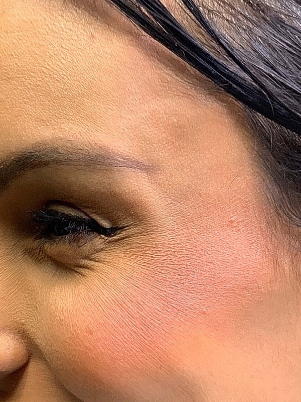 Botox Before & After