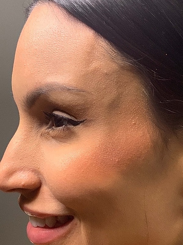 Botox Before & After