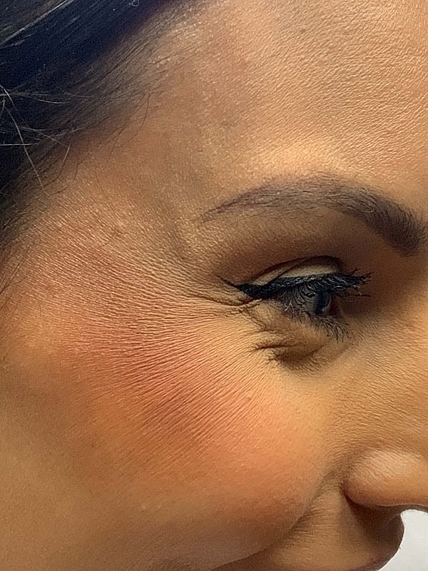 Botox Before & After