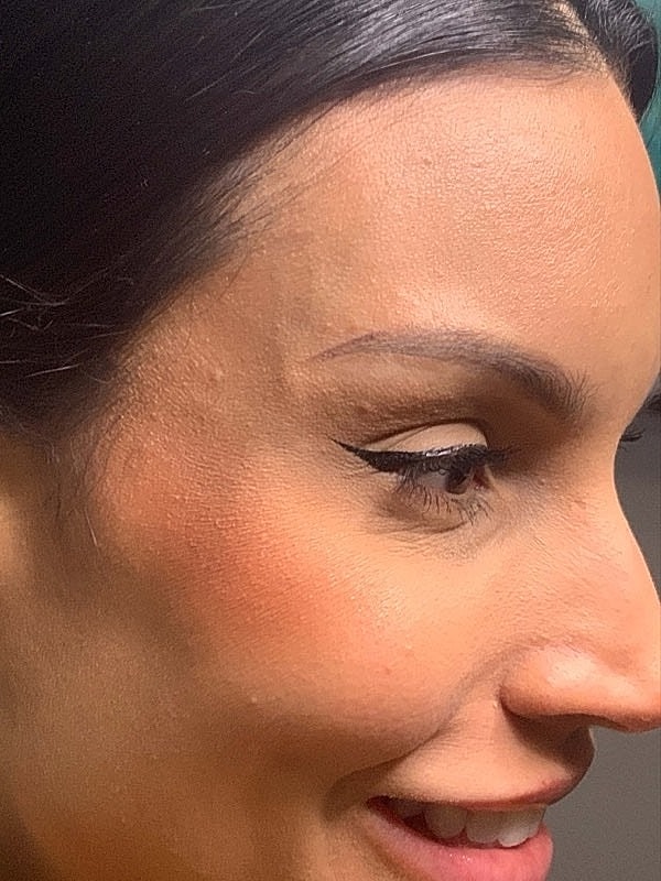 Botox Before & After