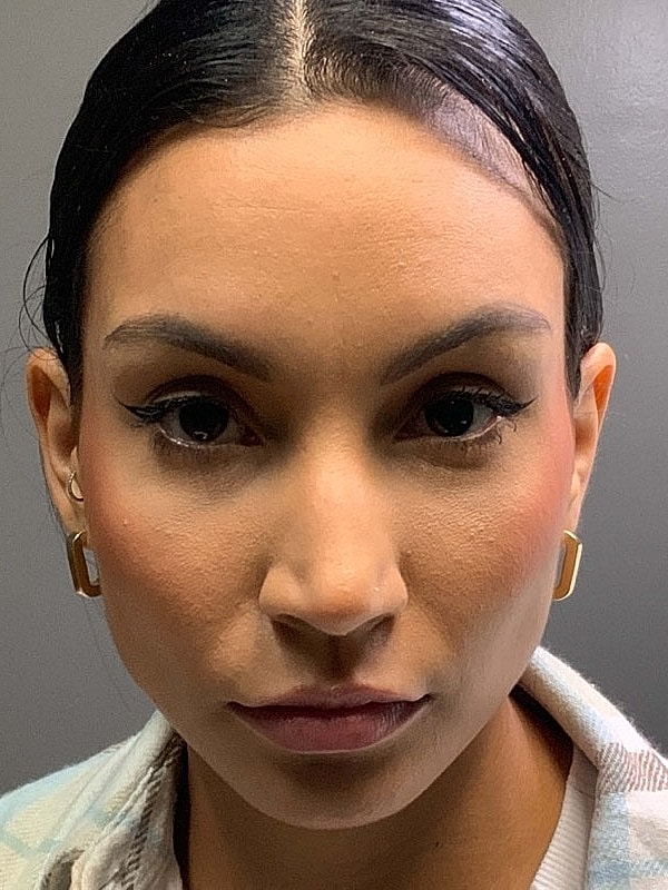 Botox Before & After