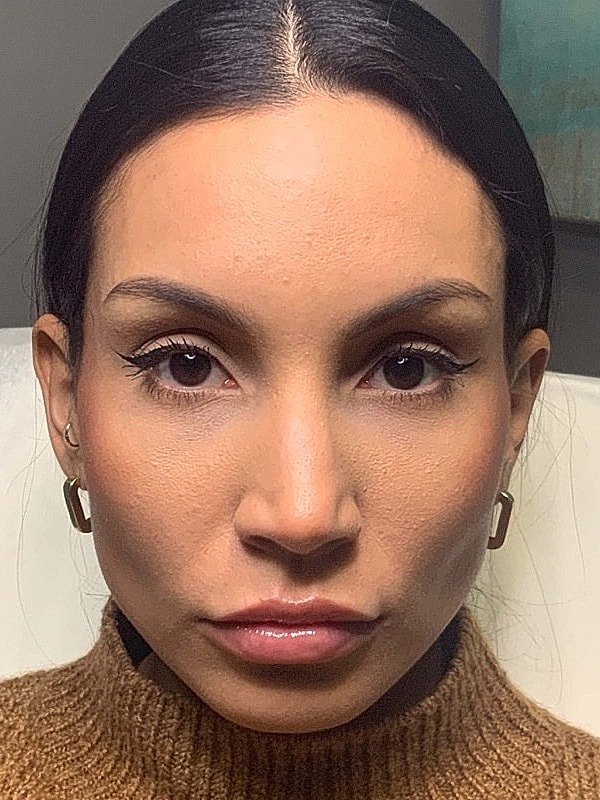 Botox Before & After