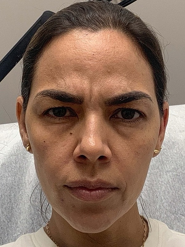 Botox Before & After