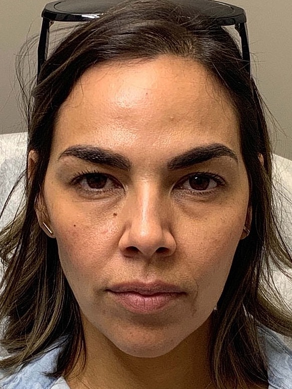 Botox Before & After